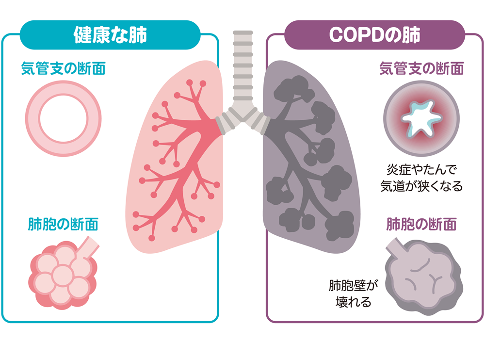 慢性閉塞性肺疾患（COPD）とは？
